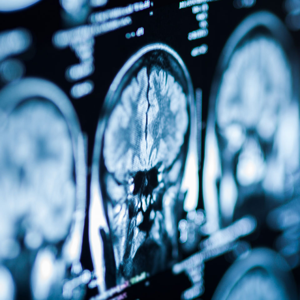 Brain Injuries | How an Accident Injury Lawyer Can Help